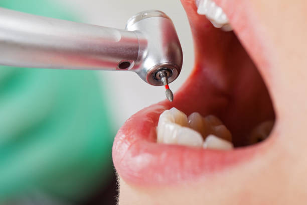 Best Emergency Dental Extractions in Pleasant Grove, OH